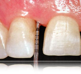 Bone regeneration materials being inserted into a bone defect