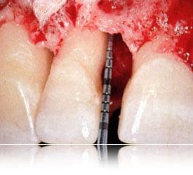 Bone regeneration materials being inserted into a bone defect