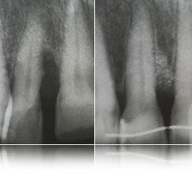 X-rays of teeth and gums before and after bone regeneration