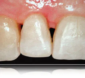 Teeth and gums after bone regeneration