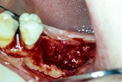 Ridge preservation procedure