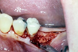 Ridge preservation procedure