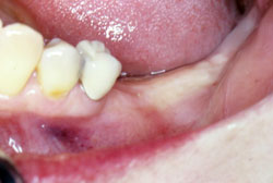Ridge preservation procedure