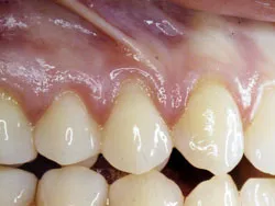Patient's mouth before gum grafting