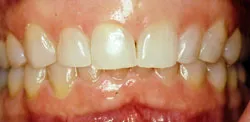 Patient's mouth before crown lengthening