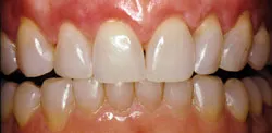 Patient's mouth after crown lengthening