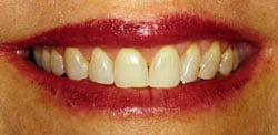 Patient's smile after crown lengthening