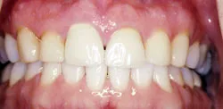 Patient's mouth before crown lengthening