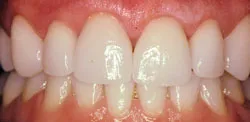 Patient's mouth after crown lengthening
