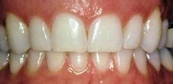 Patient's mouth before crown lengthening