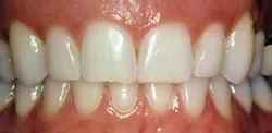 Patient's mouth before crown lengthening