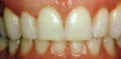 Patient's mouth after crown lengthening